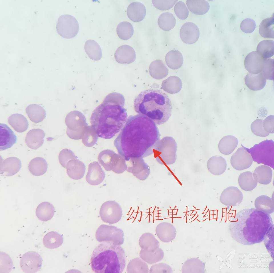 如何镜下区分淋巴细胞跟单核细胞 - 临床检验医学讨论版 - 专业医生社