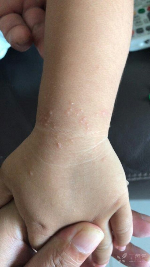 小儿腕部皮疹待诊