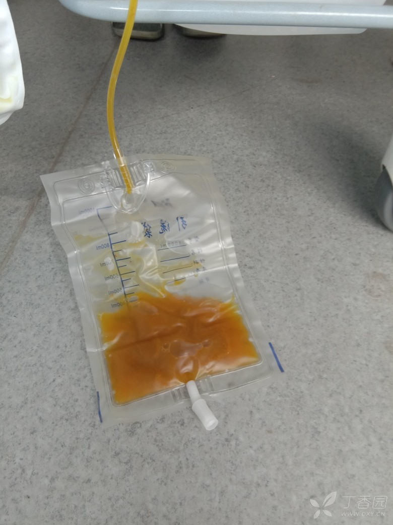 hartmann手术术后,肠瘘,肛门流粪水,还有得救吗?