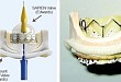 ViV-TAVR 与 redo-SAVR 孰优孰劣