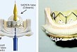 ViV-TAVR 与 redo-SAVR 孰优孰劣