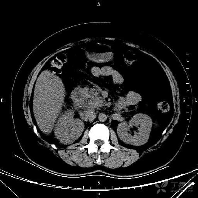 肾ct片图片