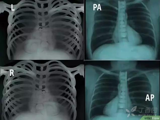 再复习一遍.pa:正位,ap:前后位,l:左侧,r:右侧.