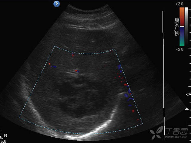 分享肝脓肿一例 - 超声医学讨论版 - 专业医生社区,医学,药学,生命
