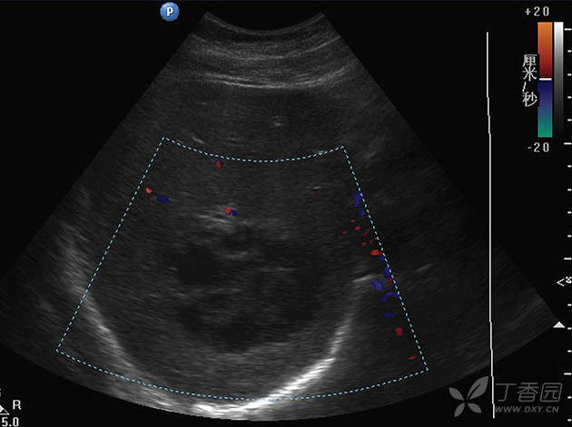 肝脓肿彩超图片