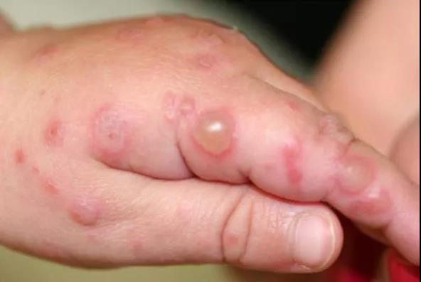 柯萨奇病毒 a6(cva6)所致手足口病(图 3)病情更严重,水疱可有疼痛,并