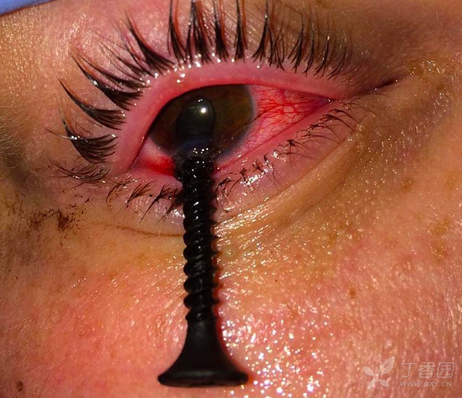 尽管医生为其进行了异物摘除及角膜缝合,但是术后他还是出现了白恼舷