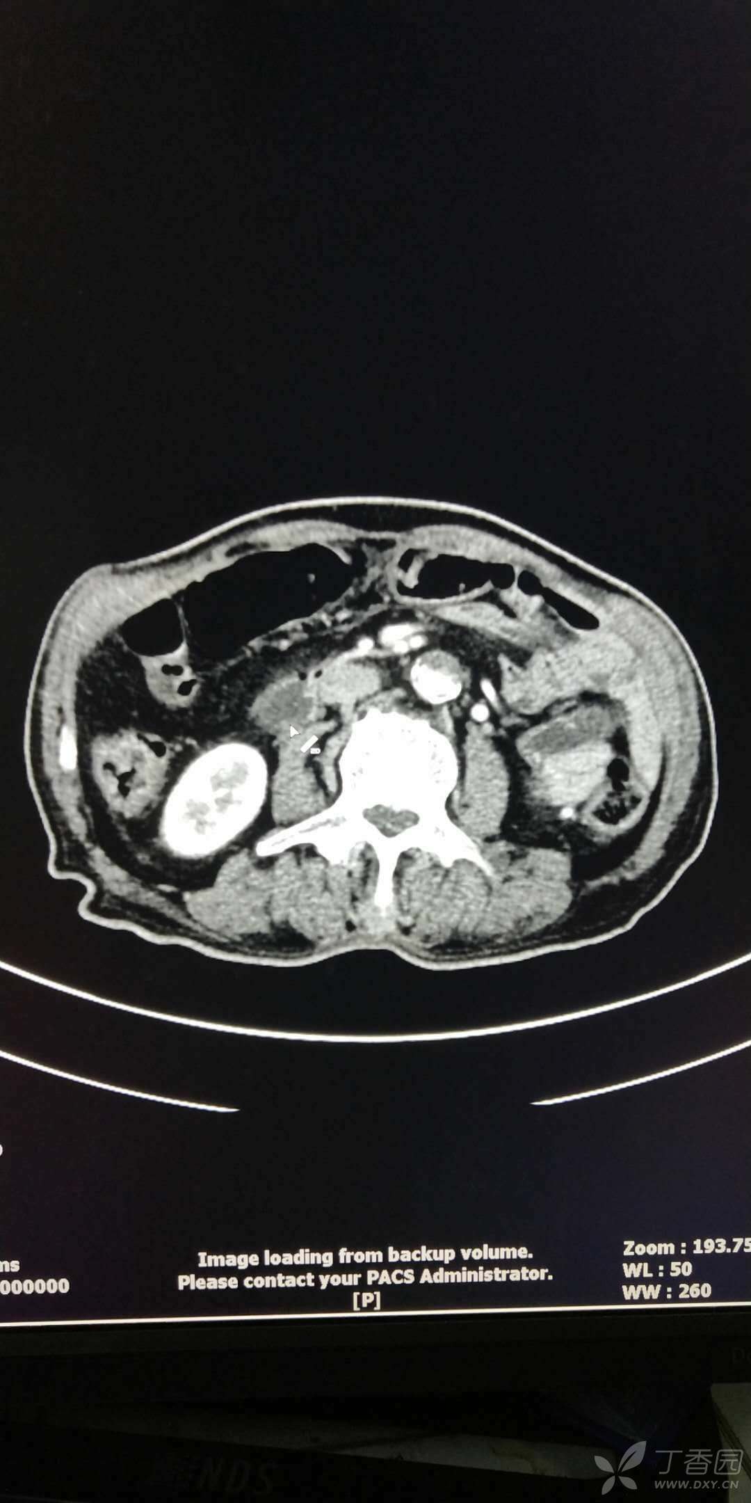 60cm,內見兩處結節樣高密度影,膽總管下端管壁增厚,壺腹部可見軟組織