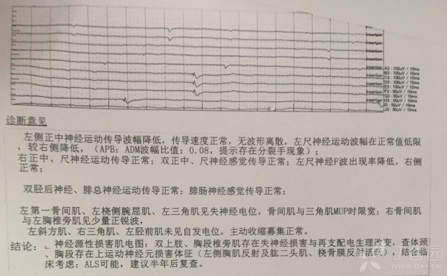 渐冻症肌电图表现图片