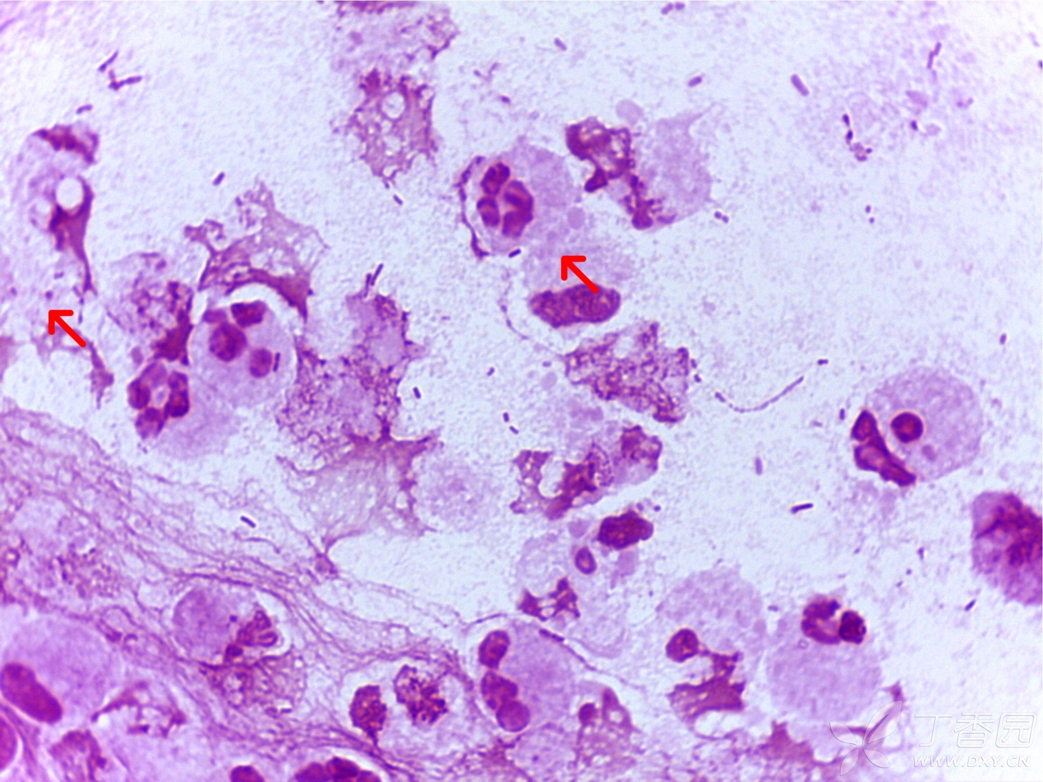 痰液抗酸染色图片