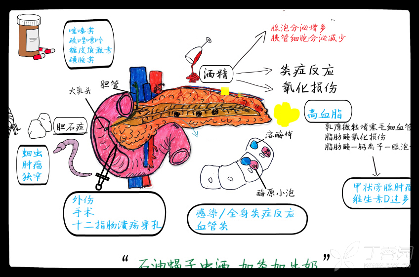 急性胰腺炎病理生理图图片