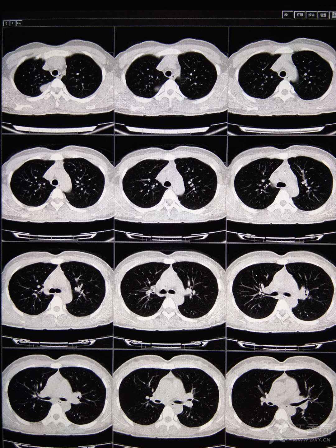 典型病例发一个,"哑铃征" ,不用鉴别诊断 - 丁香园论坛