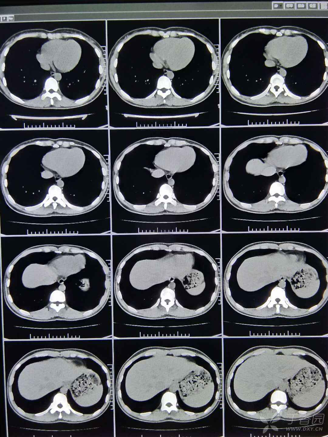 典型病例发一个,"哑铃征" ,不用鉴别诊断 - 丁香园论坛