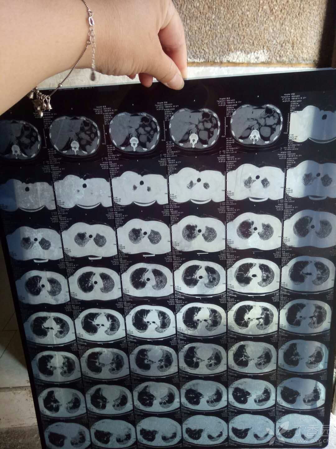 百草枯中毒肺部图片图片