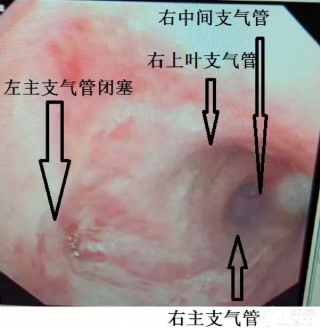 还想着左主支气管应该有条缝隙,没想到,做纤支镜的时候,到了隆突上方