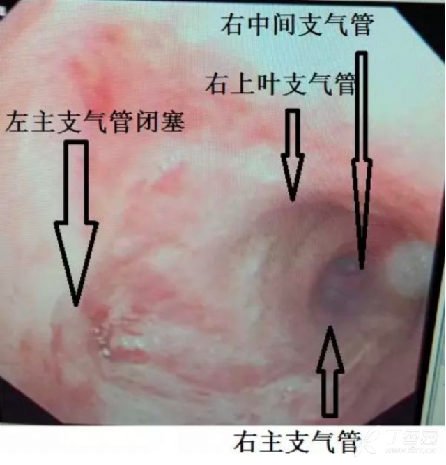 气管隆突角图片