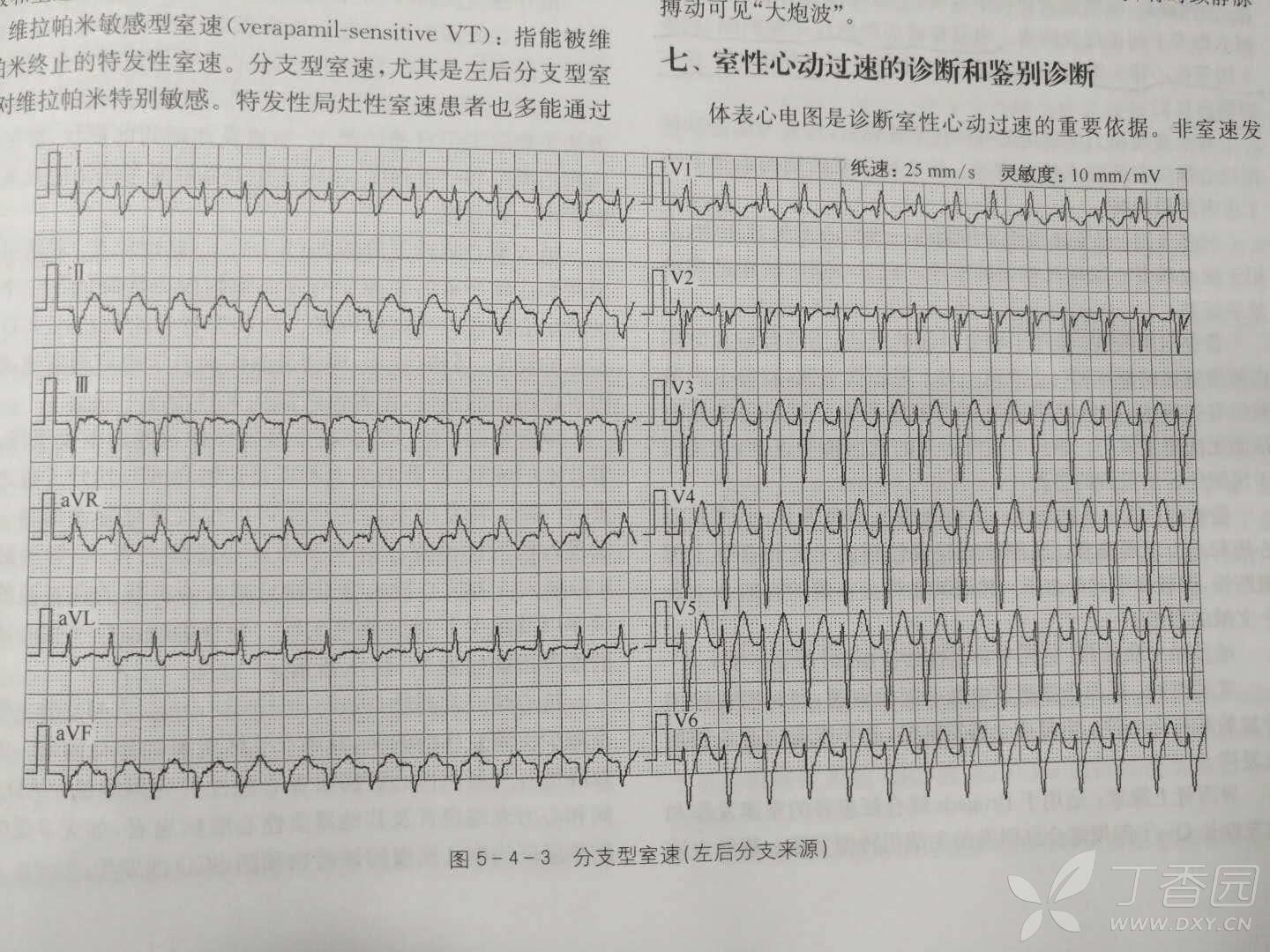 如何理解左后分支室性心动过速表现为左前分支传导阻滞图形 心血管专业讨论版 丁香园论坛