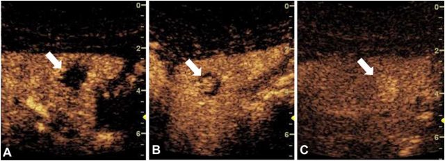 超声子宫输卵管造影 超声造影：在肿瘤诊断和介入治疗中的最新应用