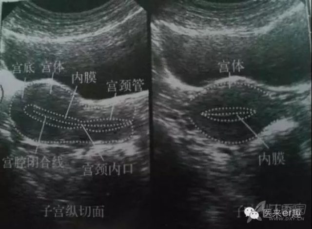 图解:常见妇科疾病典型超声表现
