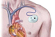 植入型心律转复除颤器在慢性肾脏病中的应用