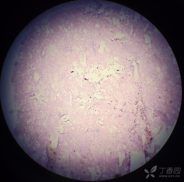 病理 局灶性间质性肺炎伴脱屑