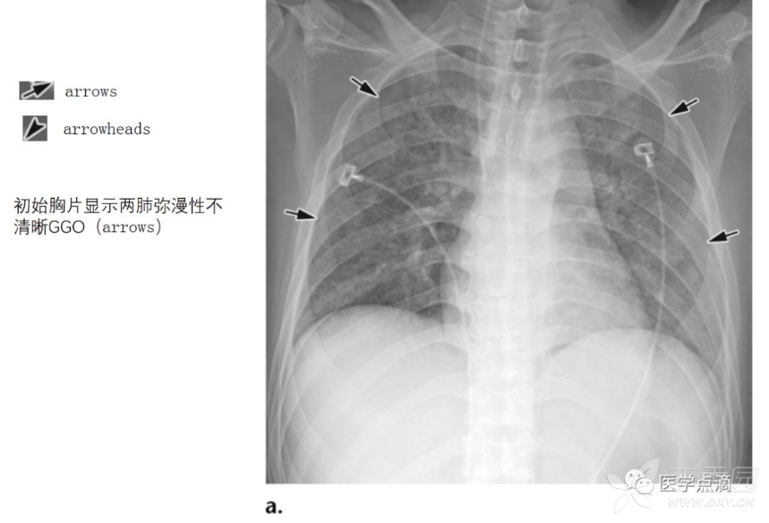 主要的影像学表现为双侧不对称ggo,小的边界不清楚的中央小叶结节,含