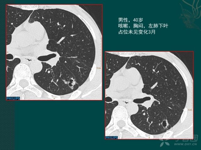 看完这篇 晋级空洞型肺癌诊断高手