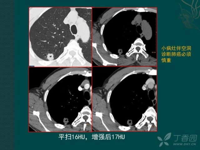 看完这篇 晋级空洞型肺癌诊断高手