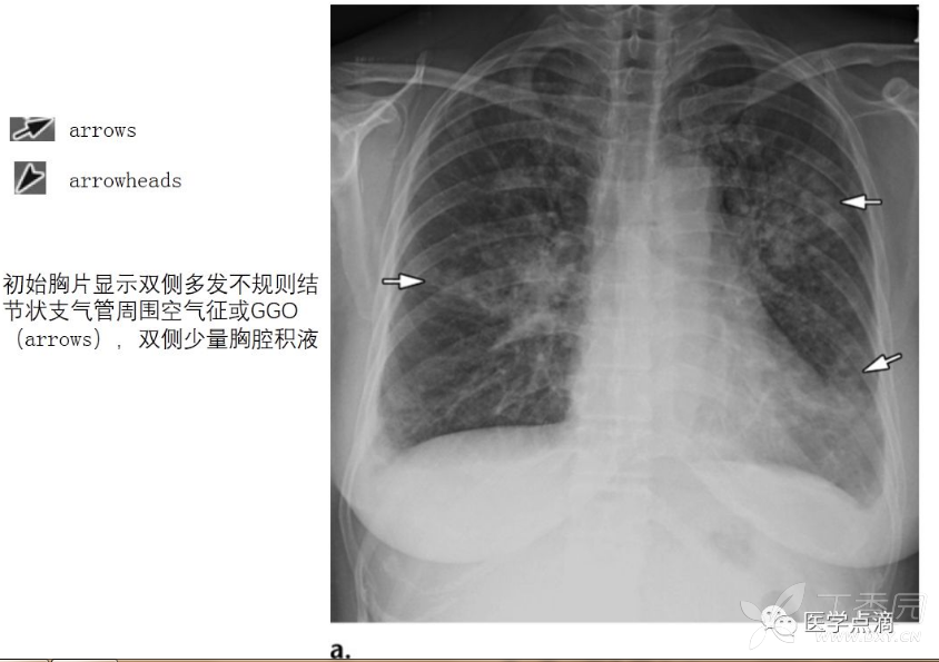 58岁女性急性髓细胞样白血病伴有发热,诊断为呼吸道合胞病毒肺炎