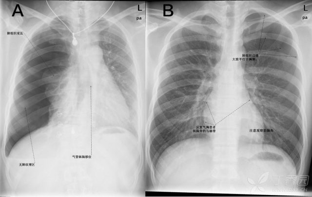 6 气胸是你A .png