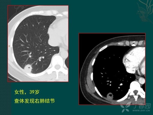 看完这篇 晋级空洞型肺癌诊断高手