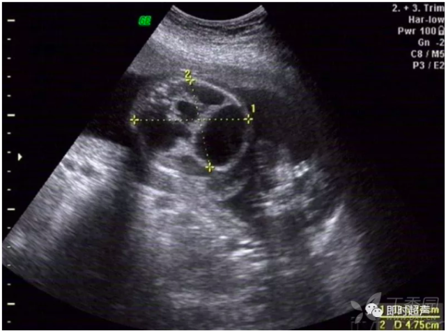 23种胎儿常见畸形的产前超声诊断,非常全面,值