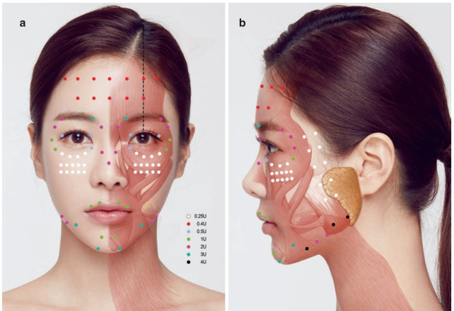 图 6 microbotox 面部注射点及剂量建议参考文献[1] kyle k seo