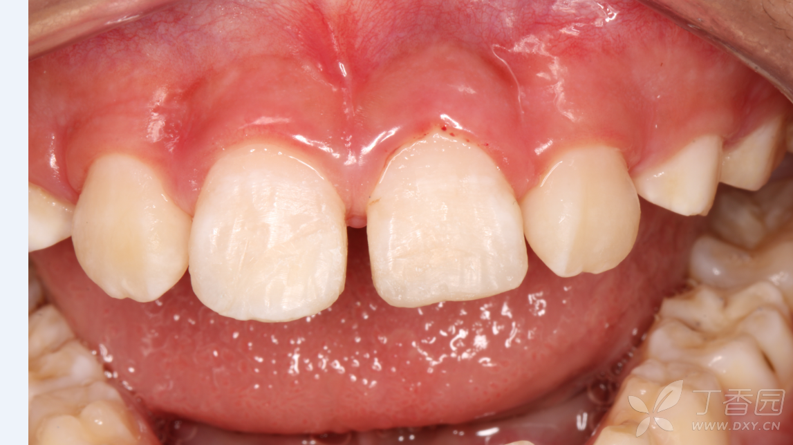 七岁断牙再接一例