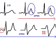 10 分钟高钾心电入门课：卢喜烈教授带你快速上手！