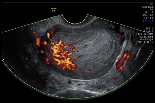 子宫内膜癌彩超图片