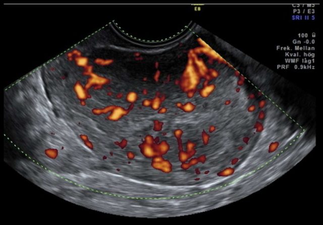 子宫内膜癌彩超图片