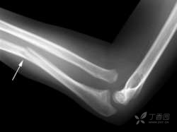 【专题】骨创伤那点事儿之不全骨折(主要分型