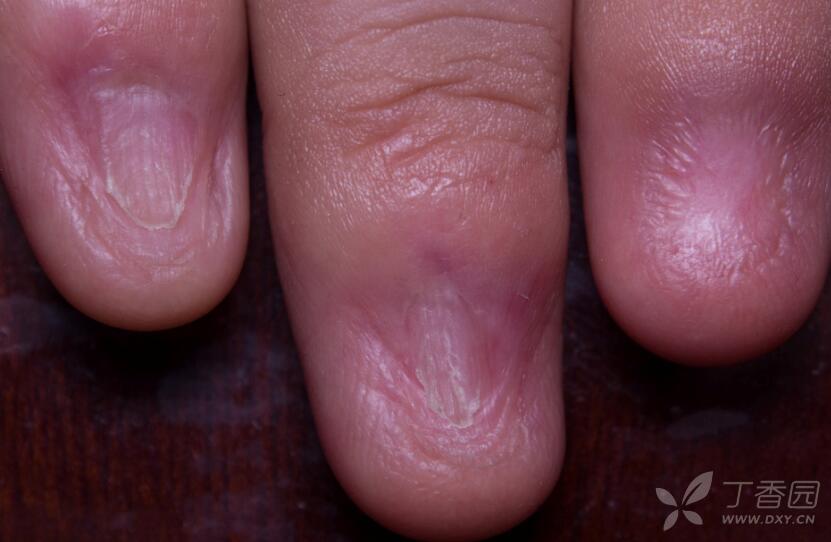 系统性红斑狼疮的指甲损害