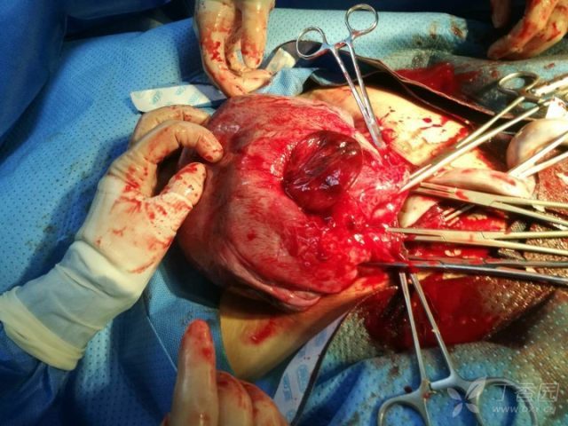 阴险型前置胎盘植入加疤痕子宫 阴险的子宫决裂，还好急性剖宫了！