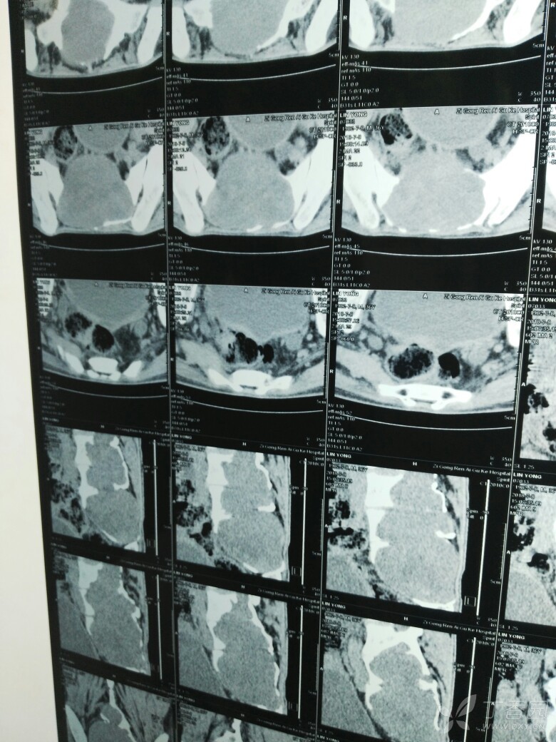 这个腰椎肿瘤怎么治?