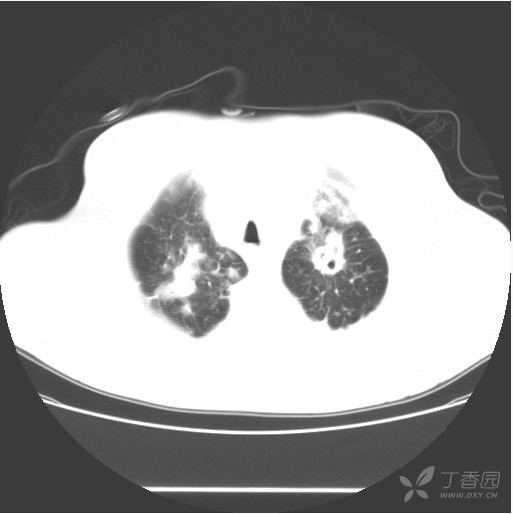 非典型类肺癌肺内搬运严峻吗 作为一个肺内典型病变，这么难确诊适宜吗？