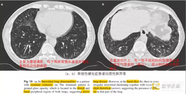 胸部CT那些事儿之肺密度增高(磨玻璃影)