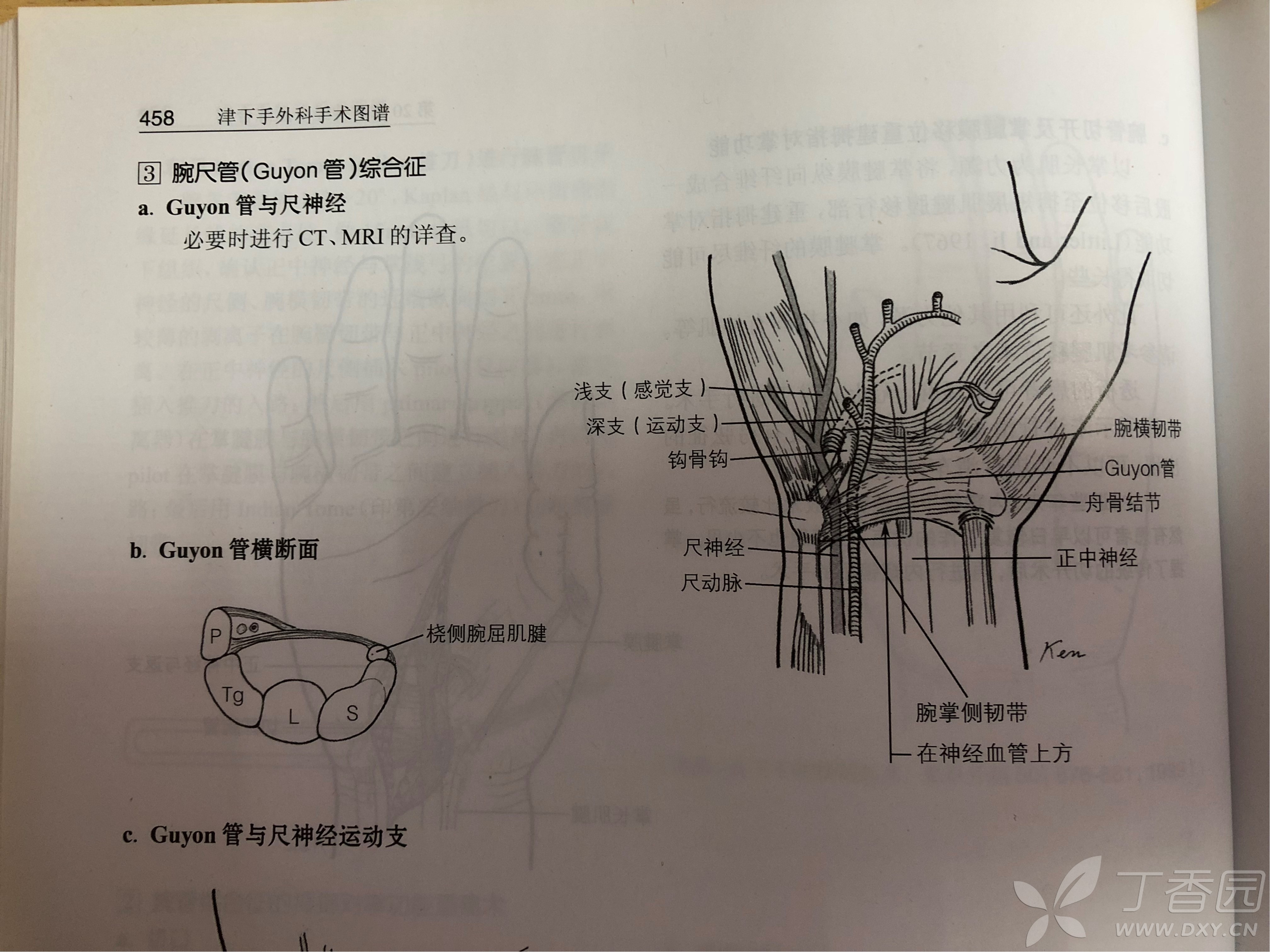 看图学手外科基础知识之1:腕尺管综合征