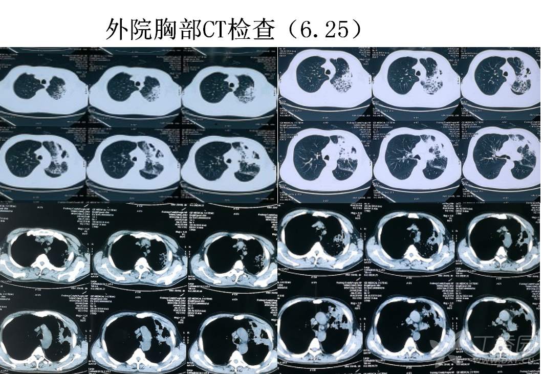 肺梗死为何影像表现高密度?各位大驾请赐教! - 丁香园论坛