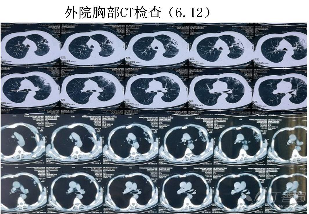 肺梗死为何影像表现高密度?各位大驾请赐教! - 丁香园论坛