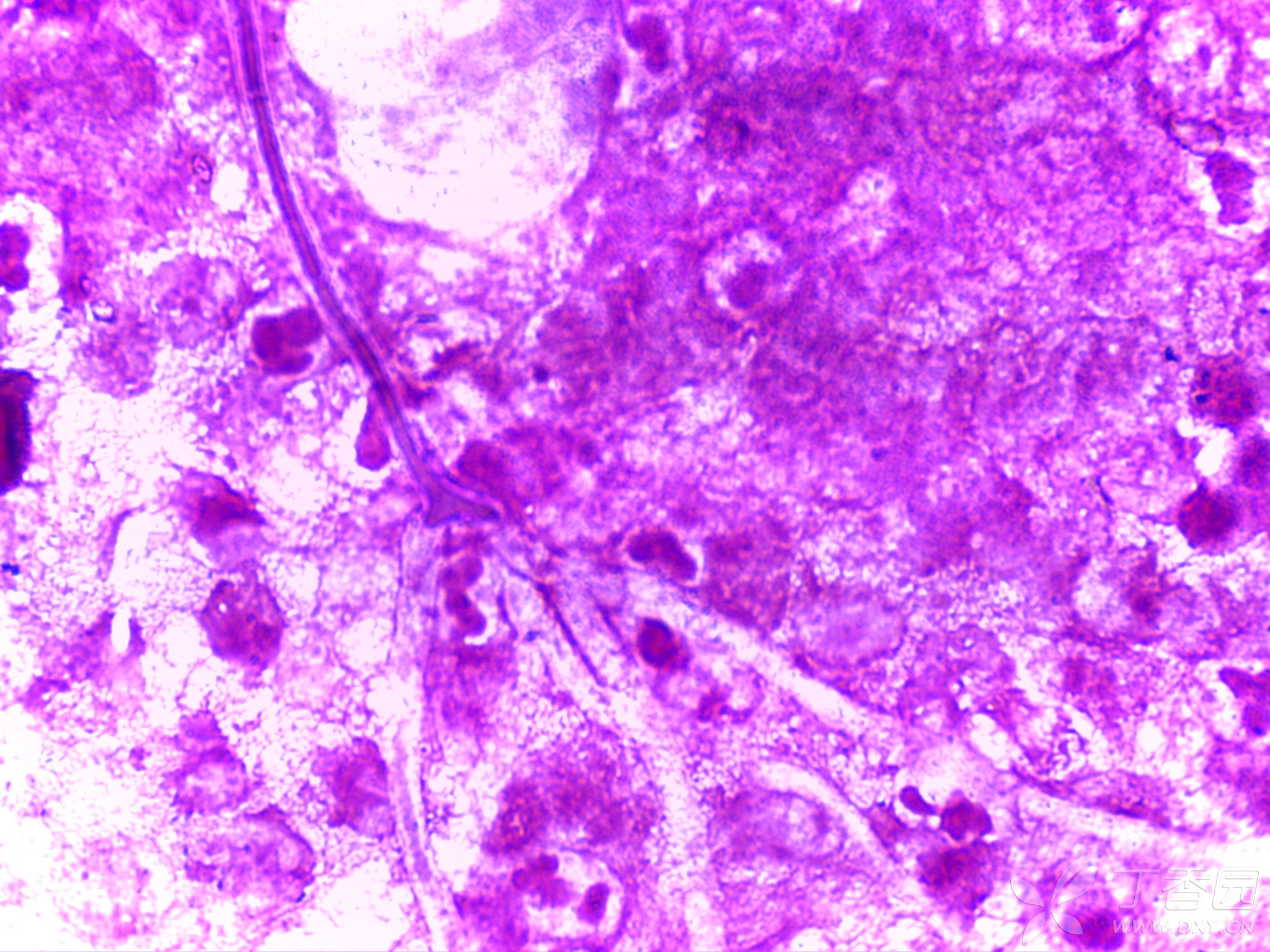 丝状菌革兰氏染色图片