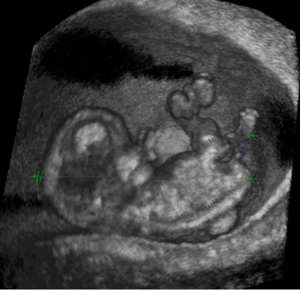 孕早期怎样判别胎儿性别 孕早期胎儿性别判定：三维虚拟现实超声牢靠吗