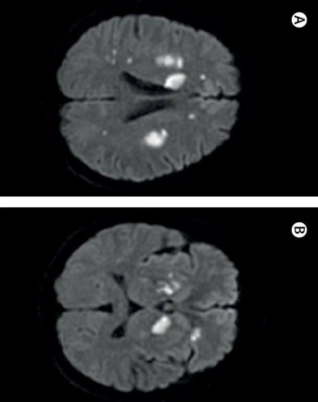 双侧髂总动脉血栓形成 Lancet：双侧颈内动脉血栓形成是怎么回事