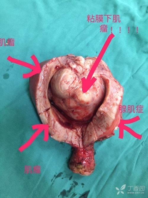 宫颈口肌瘤图片图片